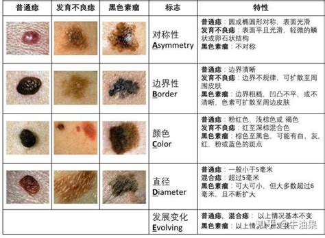 痣很凸|痣是什麼？會變成黑色素瘤？7種一定要除的痣